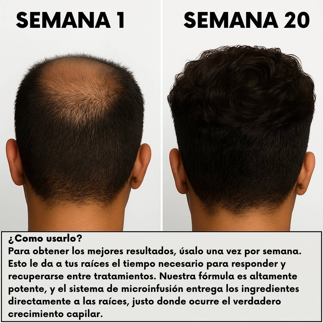 RegenCapilar™ Sérum Intensivo - Sistema de Regeneración Capilar - RegenCapilar